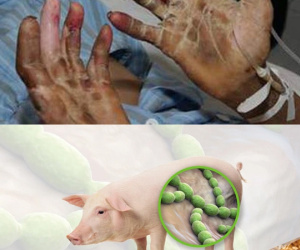 Bộ Y tế ra công văn 'nóng' cảnh báo về căn bệnh nguy hiểm lây từ lợn sang người