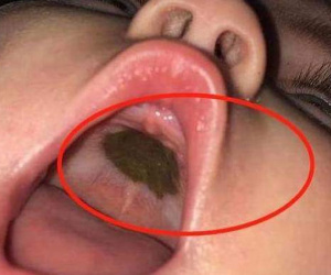 Phát hiện đốm đen kỳ lạ trong miệng con, mẹ lập tức đi khám, bác sĩ nói: Thật đáng mừng!