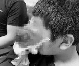 Phẫu thuật cắt bỏ khối u quái ác che lấp cả khuôn mặt bé trai 4 tuổi