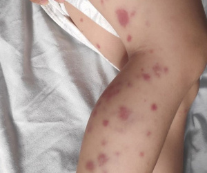 Bé trai lộ bệnh như bị 'bạo hành' khiến cha mẹ một phen sợ hãi