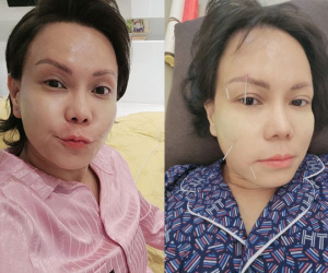 Việt Hương bị méo mặt, toàn thân phủ kín bởi 50 cây kim châm cứu