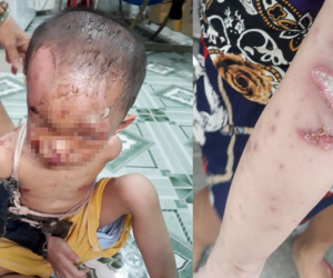 Nghi vấn bé trai ở TPHCM bị cha mẹ đánh đập dã man, trên người đầy vết thương