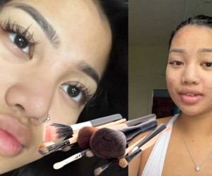 Cô gái 22 tuổi nhiễm giun đũa khắp mặt do dùng chung cọ trang điểm