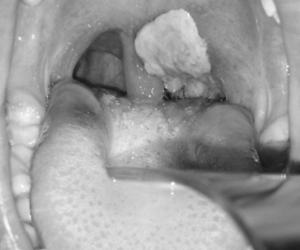 Bé gái 10 tuổi tử vong do bạch hầu