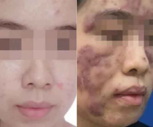Cô gái 19 tuổi biến dạng mặt, nguy cơ mù vì đơn thuốc của 'bác sĩ online'