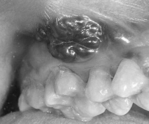 Từ ổ loét miệng, 6 tháng sau thành ung thư giai đoạn muộn