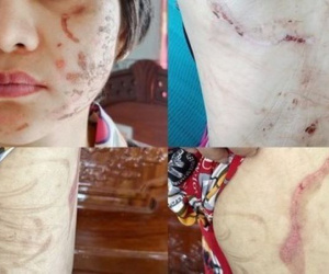 Thai phụ bị chồng bạo hành dã man như thời trung cổ kể lại quá trình trốn chạy về quê mẹ