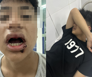 Nam sinh ở Đà Nẵng bị nhóm thanh niên đánh gãy 4 răng, nhấn xuống biển