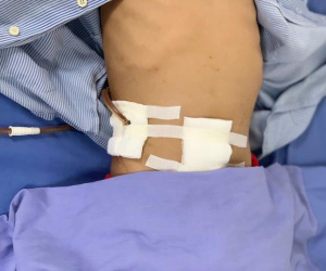 Bé trai bị que sắt đâm thấu bụng
