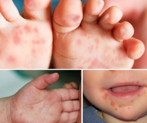 Dấu hiệu trẻ mắc tay chân miệng trở nặng, cha mẹ cần chú ý kẻo 'hối không kịp'
