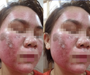 Mặt bỏng rát, bong tróc như da rắn sau khi bôi thuốc tại spa, cô gái trẻ hoảng hốt cầu cứu bác sĩ