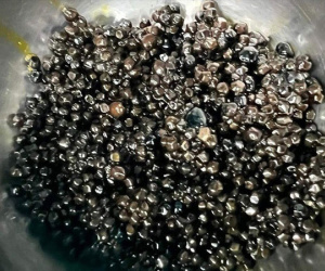 Cụ bà 73 tuổi có hàng nghìn viên sỏi trong túi mật