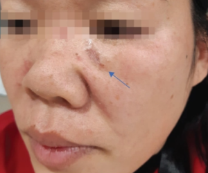 Vì sao ung thư da lại tăng vào mùa hè?
