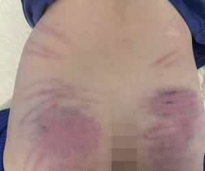 Hà Nội: Bé 9 tuổi chậm phát triển nghi bị cô giáo bạo hành dã man