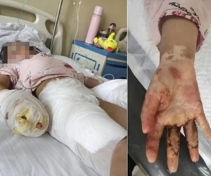 Mẹ kế nhúng tay con riêng của chồng vào nước sôi sau khi cãi nhau