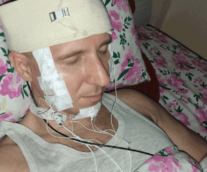 Người đàn ông suýt chết vì tự khoan hộp sọ để 'kiểm soát giấc mơ'