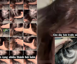 Tất tần tật để hồi sinh đầu hói thành mái tóc siêu dày mượt như mẫu quảng cáo dầu gội