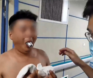 Hồi hộp theo dõi bác sĩ giải thoát chiếc bóng đèn 'mắc kẹt' trong miệng người đàn ông