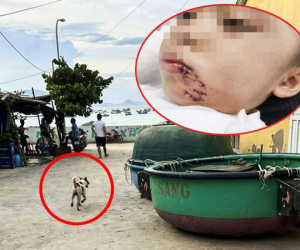 Đi du lịch cùng gia đình, cháu bé 3 tuổi bị chó cắn phải khâu 32 mũi