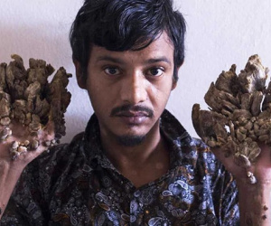 Ám ảnh 'án chung thân' trong chính cơ thể mình của người cây Bangladesh