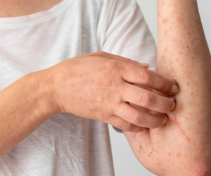 Thời tiết thay đổi khiến nhiều người tái phát viêm da cơ địa, bác sĩ khuyến cáo cách xử lý