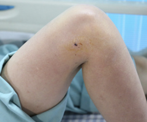Bị gà trống mổ vào chân, người phụ nữ sốt 40 độ phải nhập viện cấp cứu