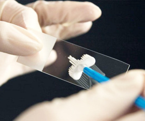 Loại virus liên quan gần 6.000 ca ung thư mỗi năm ở Việt Nam