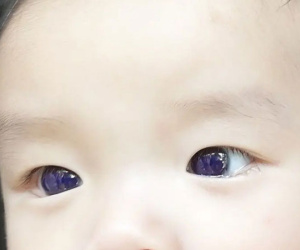 Mắt đổi màu chỉ sau một đêm uống thuốc điều trị bệnh quen thuộc