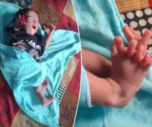 Em bé sinh ra với 26 ngón tay chân, bố mẹ mừng ra mặt vì một điều
