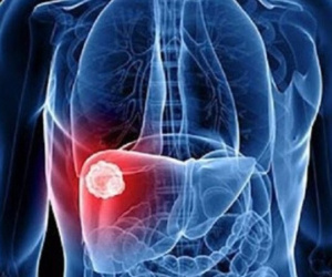 10 dấu hiệu cảnh báo căn bệnh ung thư rất phổ biến tại Việt Nam