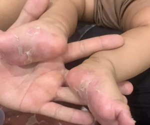Bé trai 3 tháng tuổi mắc giang mai