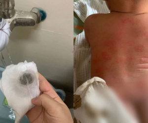 Sở Xây dựng Hà Nội lên tiếng vụ hàng trăm cư dân nổi mẩn ngứa, bong tróc da khi dùng nước sinh hoạt