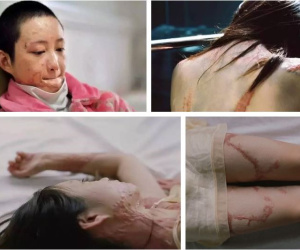 Khúc mắc tình cảm với thiếu gia nhà giàu, cô gái 16 tuổi bị 'hủy dung': Hành trình sống tiếp khó như lên trời