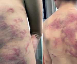 Bé trai 5 tuổi chi chít vết thương khắp người do cha ruột đánh