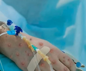 Người mắc đậu mùa khỉ đầu tiên tử vong ở Việt Nam nhiễm HIV