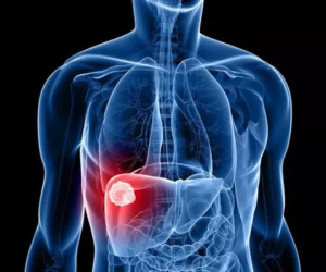 6 dấu hiệu cảnh báo ung thư gan nhiều người bỏ sót