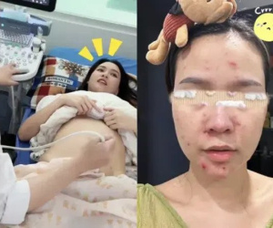 Hot girl Sam lộ nhan sắc tàn phai khi mang thai: Cả người nổi đầy mụn đỏ, không dám đi ra đường
