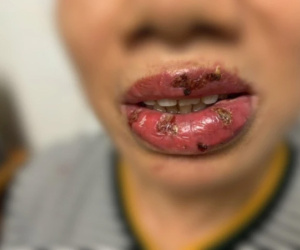 Biến chứng nguy hiểm khi xăm môi