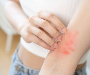 Ngứa da sau khi tắm cảnh báo nguy cơ mắc bệnh gì?