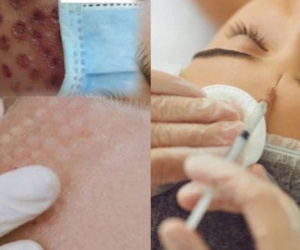 Tưởng tiêm meso căng bóng da, có người đau đớn nhận lại khuôn mặt 'rỗ như tổ ong', ai nhìn cũng phải xót xa
