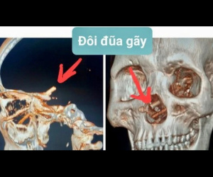 Đôi đũa nằm trong hộp sọ 5 tháng mà bệnh nhân không hề biết