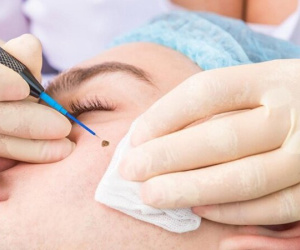 Tẩy nốt ruồi có đổi vận không?