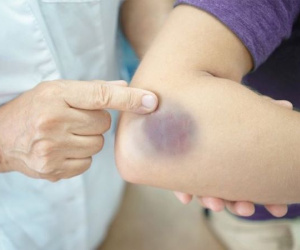 Từ vụ Châu Hải My qua đời: Vết bầm tím trên da có thể là dấu hiệu của 7 căn bệnh nguy hiểm này