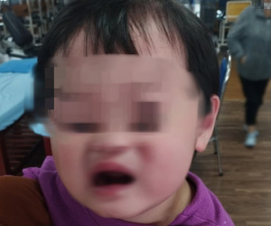 Bé 2 tuổi méo miệng, liệt dây thần kinh số 7 do trời lạnh