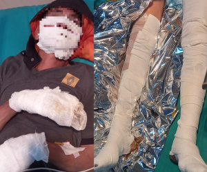 Điện thoại ở đầu giường phát nổ, 2 vợ chồng bị bỏng nặng