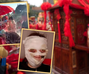 Cô dâu Trung Quốc bỏng nặng khắp mặt vì dụng cụ phổ biến trong đám cưới