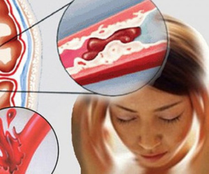 Nữ sinh 15 tuổi bất ngờ đột quỵ ở trường học, trước khi đột quỵ có biểu hiện này!