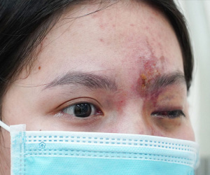 Làm đẹp cuối năm, nhiều người mất Tết vì biến chứng