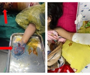 Bé gái bị nổ dập nát tay vì nhặt pháo hoa nhà hàng xóm đốt