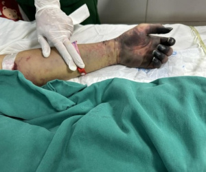 Nam bảo vệ nguy kịch do nhiễm vi khuẩn trong 'món khoái khẩu'